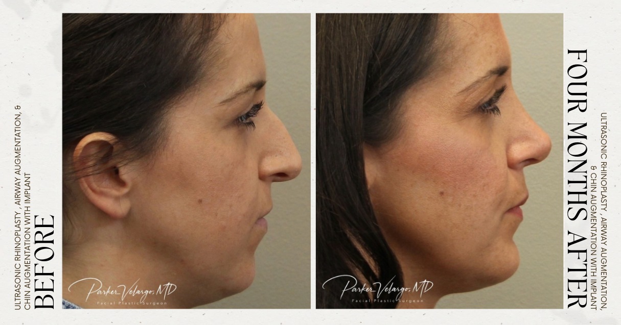 before and after rhinoplasty female patient side view case 12250