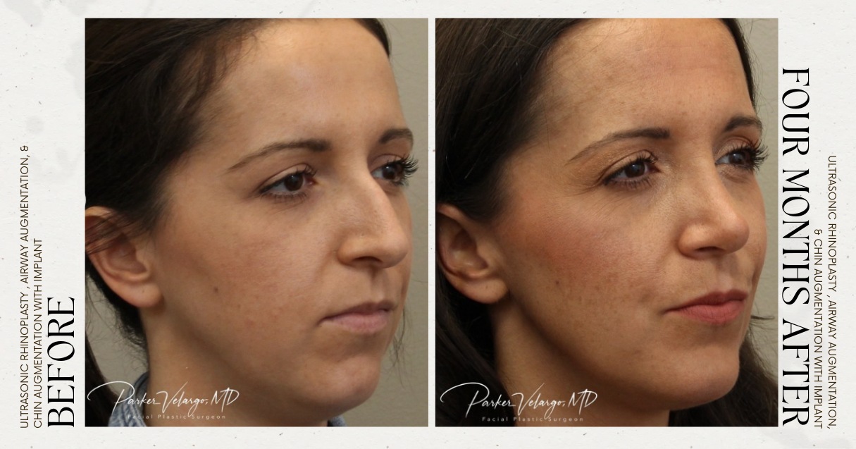 before and after rhinoplasty female patient angle view case 12250