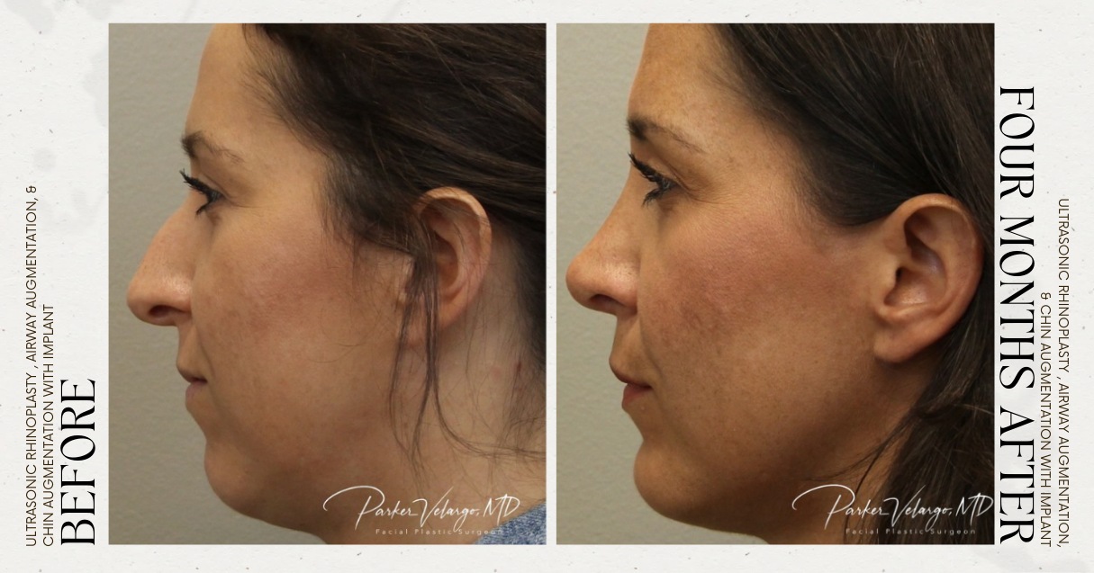 before and after rhinoplasty female patient left side view case 12250
