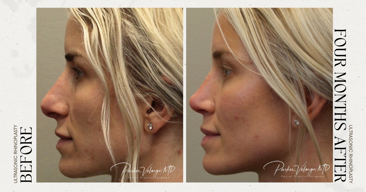 before and after rhinoplasty female patient left side view case 21259