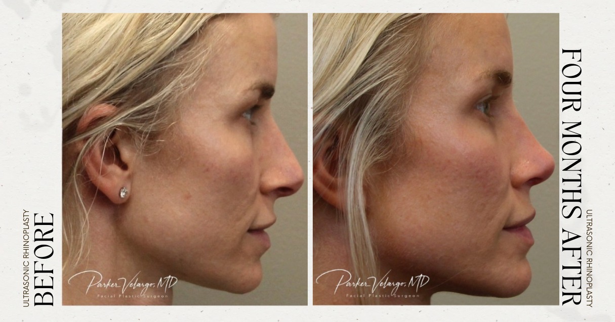 before and after rhinoplasty female patient side view case 21259