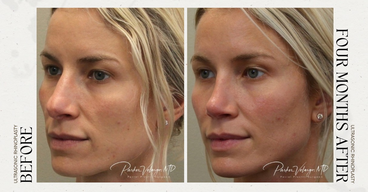 before and after rhinoplasty female patient left angle view case 21259