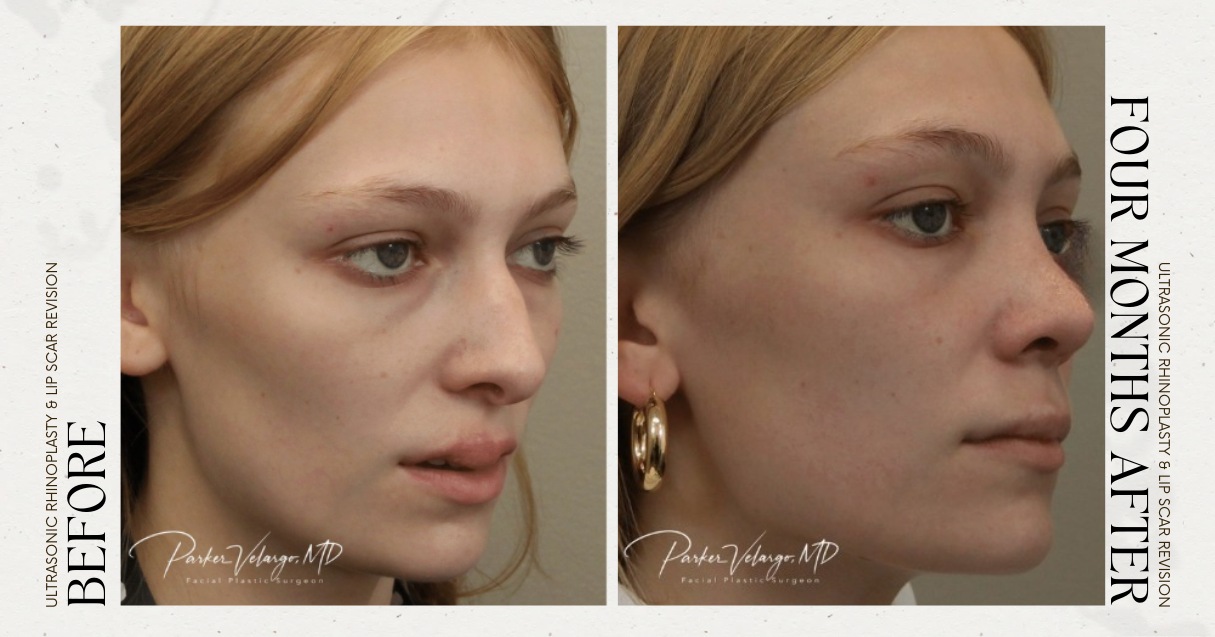 before and after rhinoplasty female patient angle view case 12266