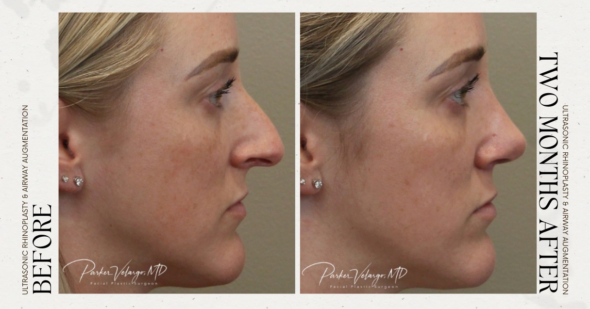 before and after rhinoplasty female patient side view case 12276