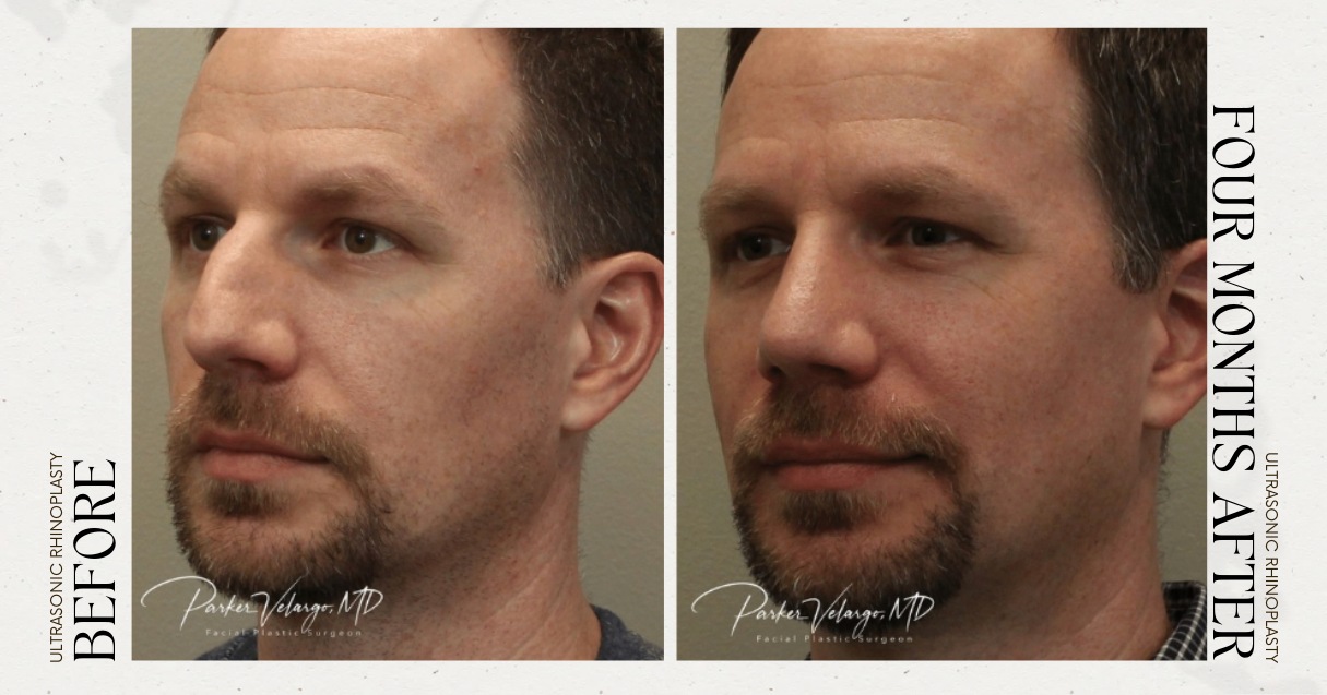 before and after rhinoplasty male patient angle view case 12283