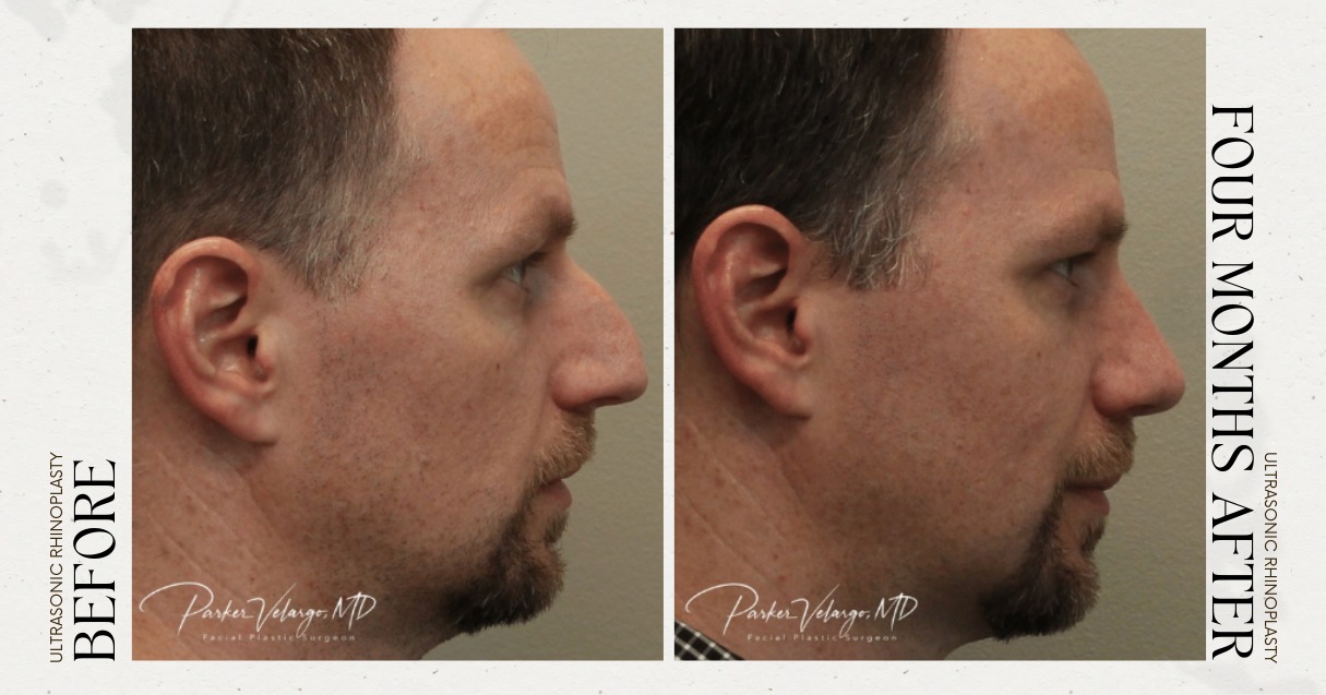 before and after rhinoplasty male patient side view case 12283