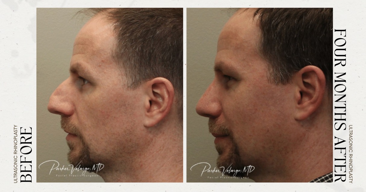 before and after rhinoplasty male patient left side view case 12283