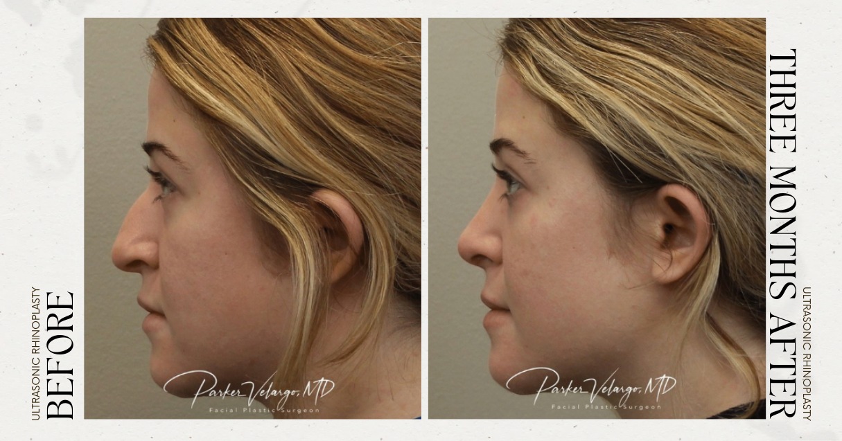 before and after rhinoplasty female patient left side view case 12297