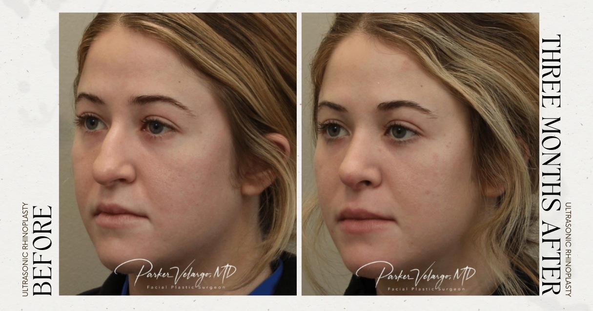 before and after rhinoplasty female patient left angle view case 12297