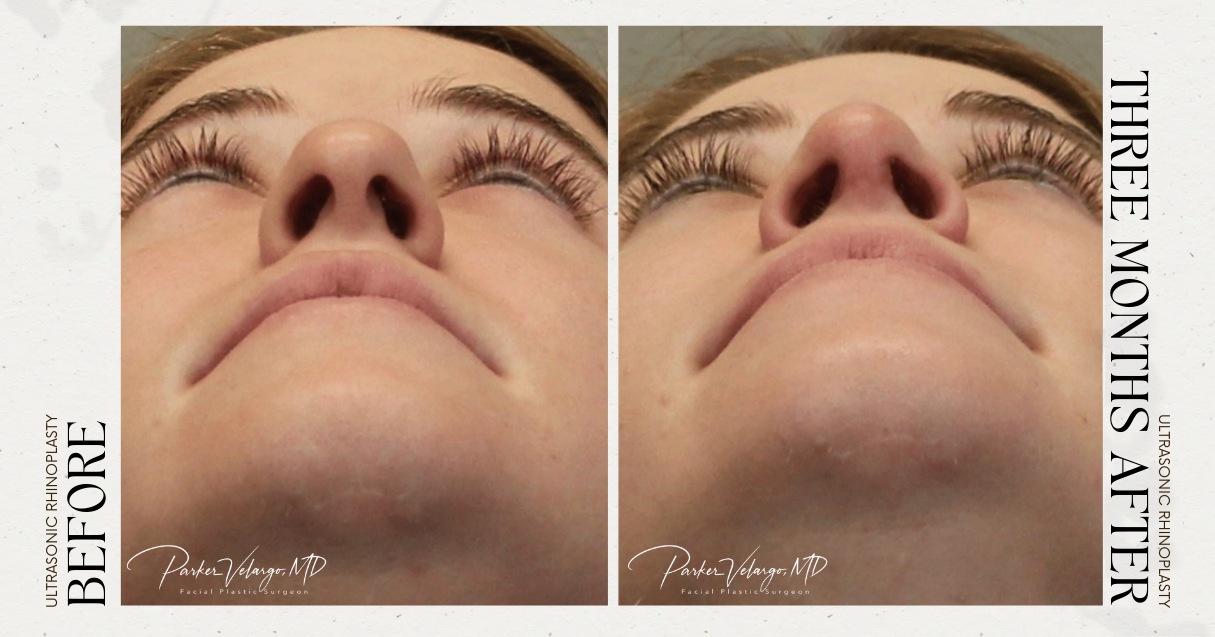 before and after rhinoplasty female patientbottom view case 12297